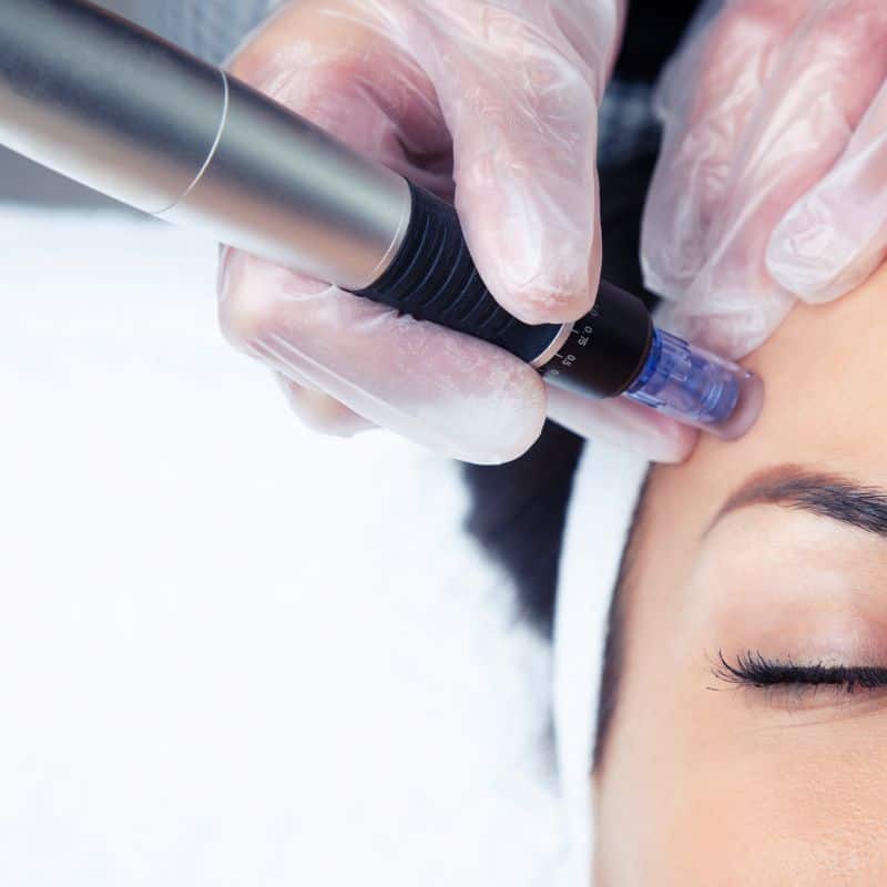 Morpheus8 treatment Harrow from Lipo Sculpt - Book in today!